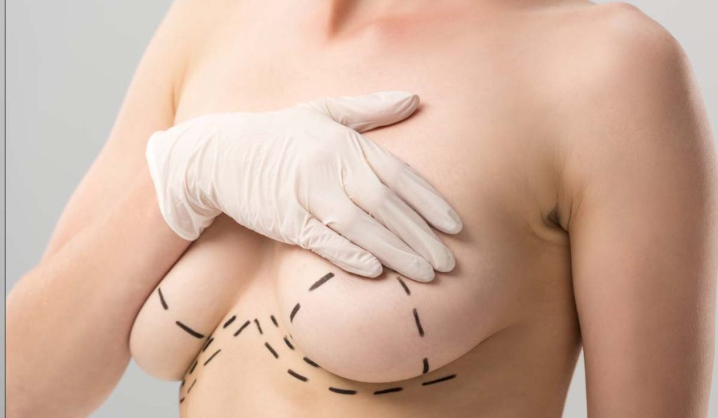 Dr Gabriel Cubillos mammoplasty